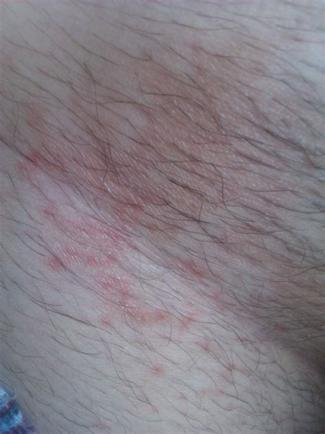  Ramsay Hunt Syndrome. . Red spots on pubic area not itchy male